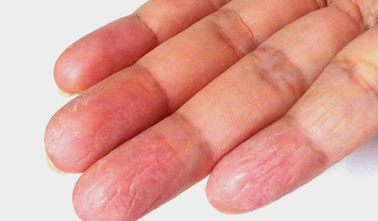 Dấu vân tay là gì? Thông tin thú vị có thể bạn chưa biết! 5 Bệnh viêm da cơ địa khiến cho bị mất dấu vân tay