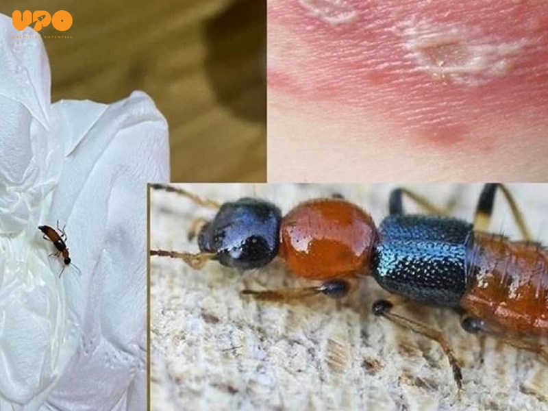 Các triệu chứng trên da khi bị kiến ba khoang cắc