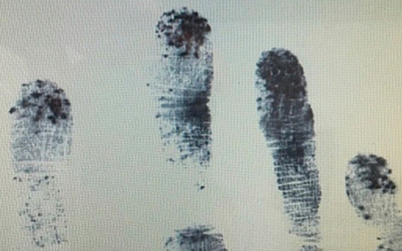 Hình ảnh các ngón tay không có vân tay của người mắc chứng Adermatoglyphia