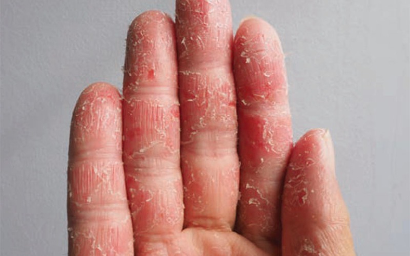 Hình ảnh người bị viêm da cơ địa bong tróc da ngón tay và bị mất dấu vân tay