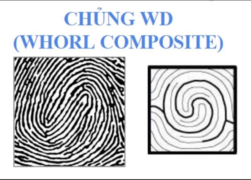 Chủng vân tay WD là viết tắt của "Whorl Double Loop”